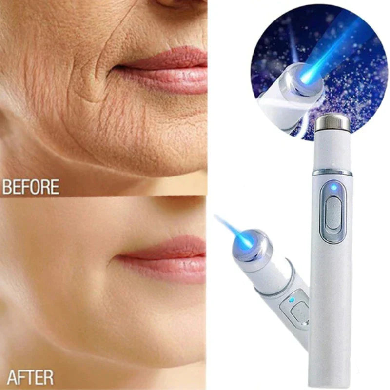 Acne Wrinkle Removal Laser Pen Skin | Best Price in Pakistan original skincare product Pakistan Main image