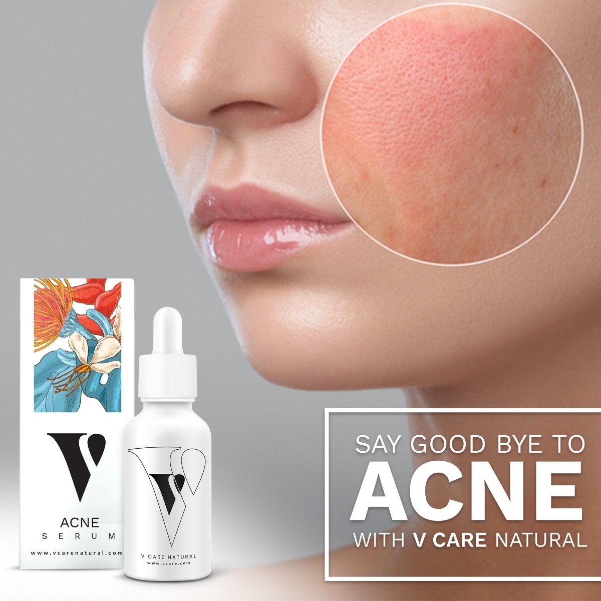 Acne Serum 30ml | Best Price in Pakistan original skincare product Pakistan Main image