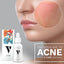 Acne Serum 30ml | Best Price in Pakistan original skincare product Pakistan