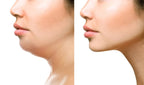 ڈبل چِن (Double Chin) ہٹائیں - چہرے کی چربی کم کریں