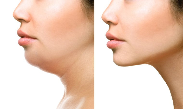 ڈبل چِن (Double Chin) ہٹائیں - چہرے کی چربی کم کریں